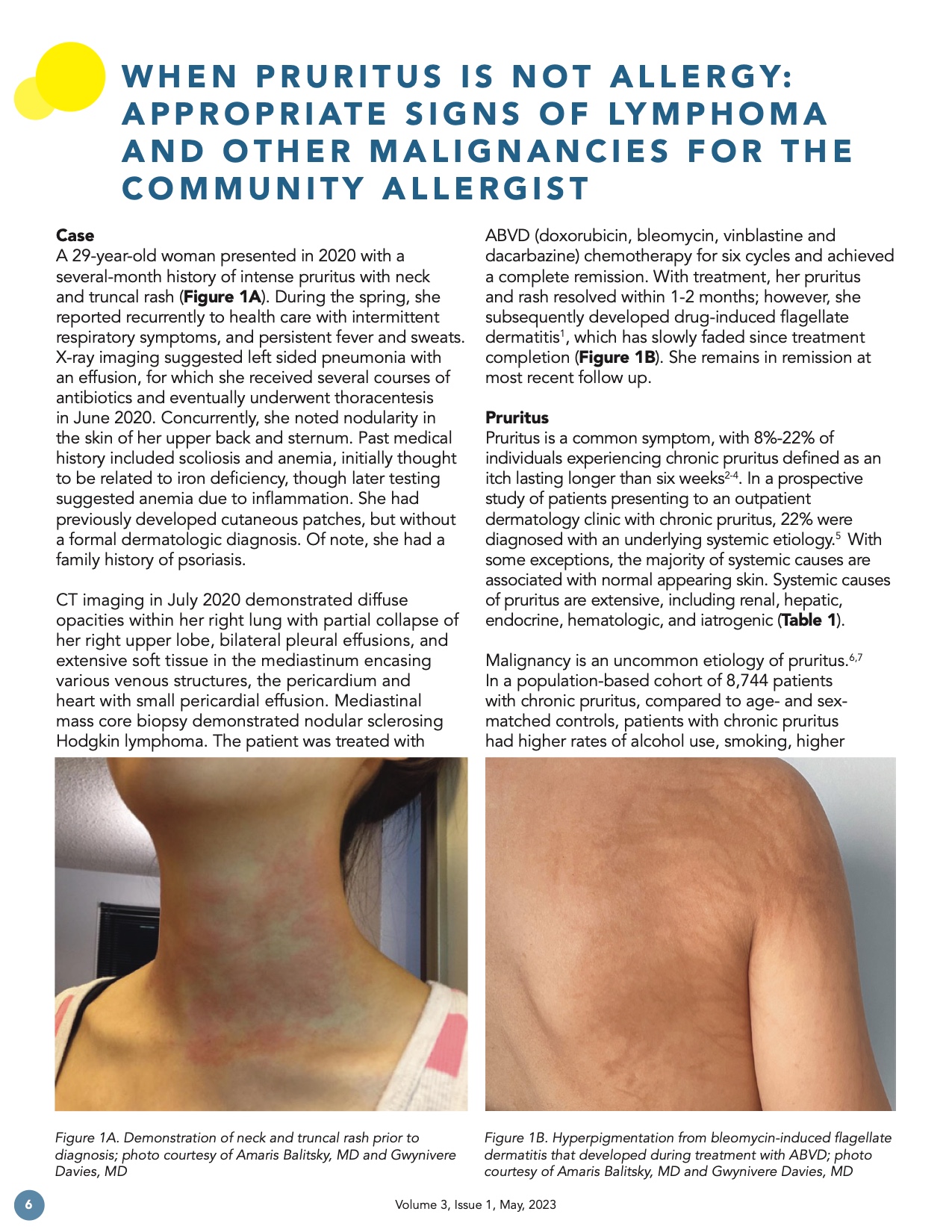 When pruritus is not allergy: appropriate signs of lymphoma and other malignancies for the community allergiest